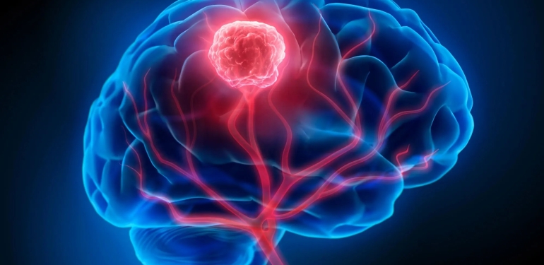 ⁠Beyin tümörünü kan testiyle tespit eden yöntem geliştirildi